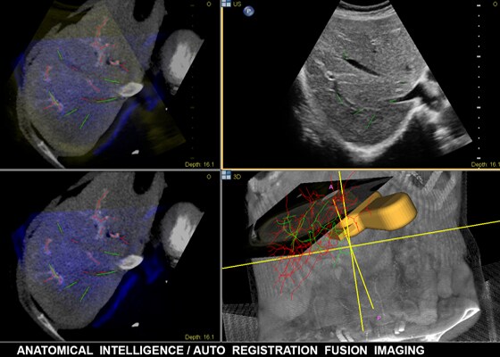 Bildfusion in der interventionellen Radiologie mit anatomischer Intelligenz​
