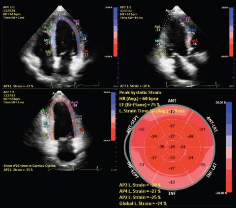 Automatisierte Quantifizierung der Wandbewegung bei der Ultraschalluntersuchung des Herzens​