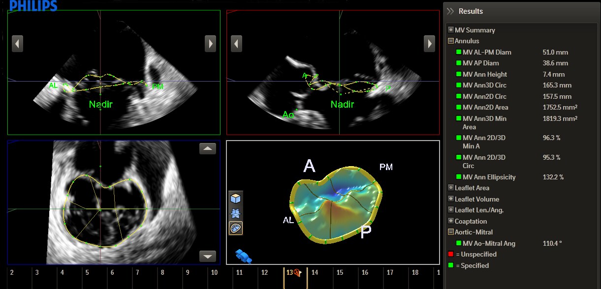 Mitralklappen-Messungen und –Berechnungen mit anatomischer Intelligenz beim Ultraschall​