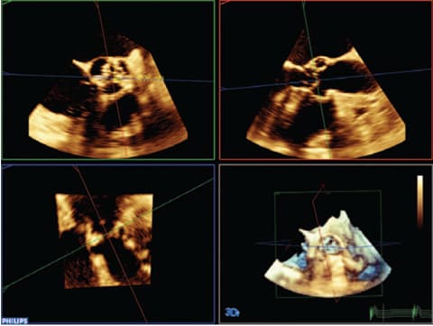 Einsatz anatomischer Intelligenz für Ultraschalluntersuchungen in der interventionellen Kardiologie​