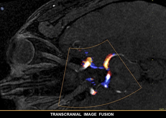 Transkranielle Bildfusion für die Kombination von Modalitäten mit Live-Ultraschall​