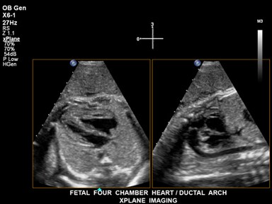 Fetale Herzen im Vierkammerblick aufgenommen mit xMATRIX-Schallkopf​