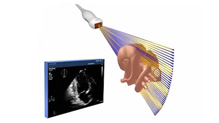 Video Vortrag von Andreas Franke über einen Schallkopf für Erstellung von 2D- und 3D-Echo​