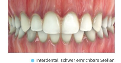 Zahnzwischenraumreinigung