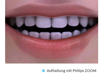 Zahnaufhellung