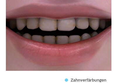 Zahnverfärbung