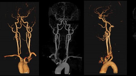 Philips Incisive CT Precise Suite (öffnet sich in einem neuen Fenster)