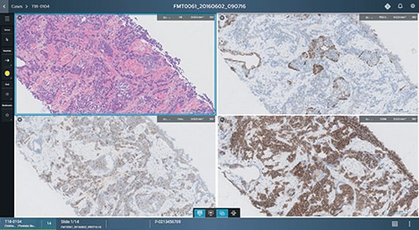 Die digitale Pathologie ermöglicht den einfachen Vergleich mehrerer Präparate, das schnelle Einholen von Zweitmeinungen und den Einsatz künstlicher Intelligenz zur Befundunterstützung. (öffnet sich in einem neuen Fenster)