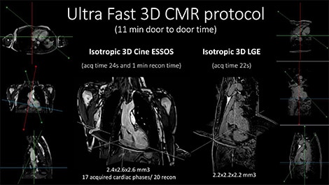 Philips und das Centro Nacional de Investigaciones Cardiovasculares Carlos III (CNIC) entwickeln neues, ultraschnelles Kardio MRT Protokoll (öffnet sich in einem neuen Fenster)