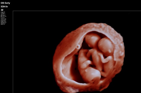 Philips Ultraschall 3D Visualisierung (öffnet sich in einem neuen Fenster)